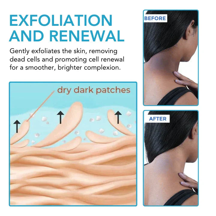 Acanthosis Nigricans Lightening Cream
