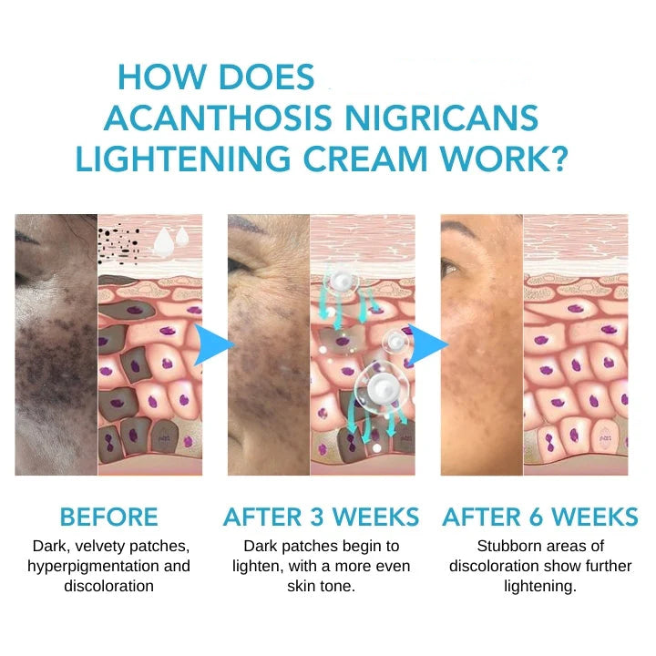 Acanthosis Nigricans Lightening Cream