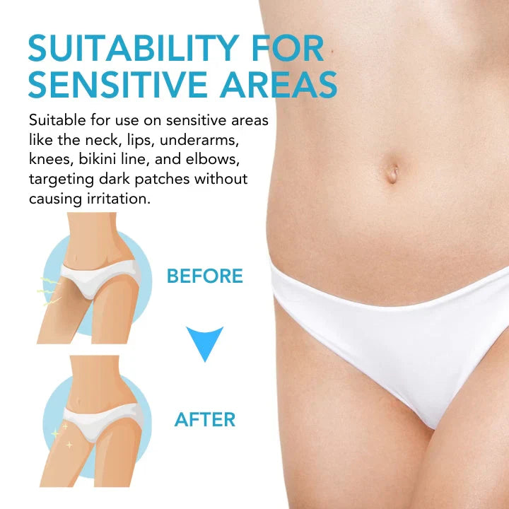 Acanthosis Nigricans Lightening Cream