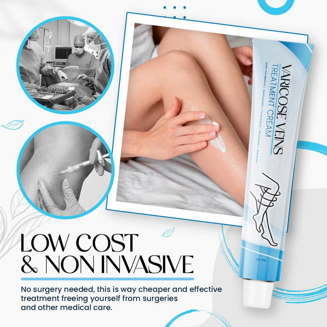 Varicose Veins Treatment Cream