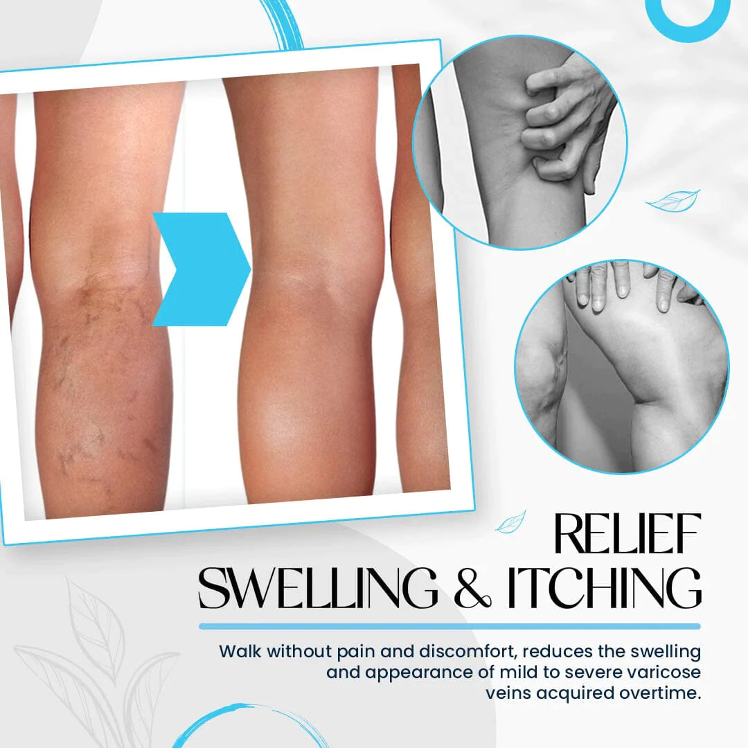 Varicose Veins Treatment Cream